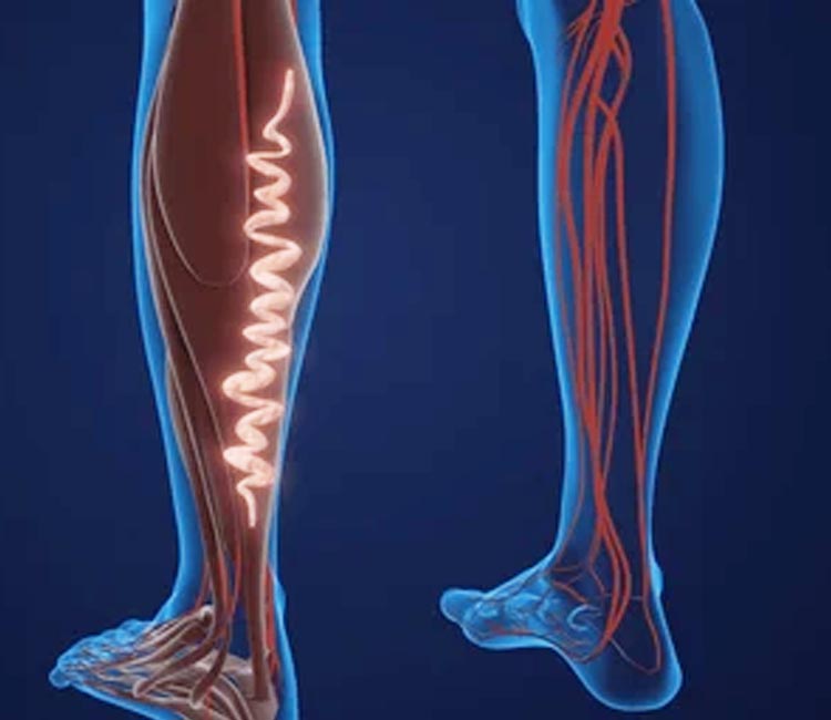 Femoral Hernia Image