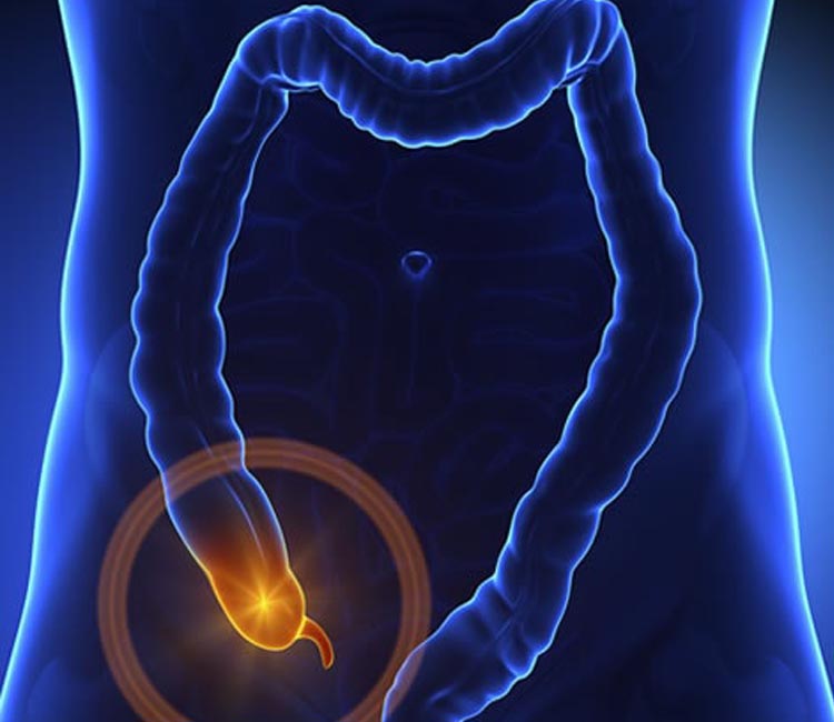 Inguinal Hernia Image