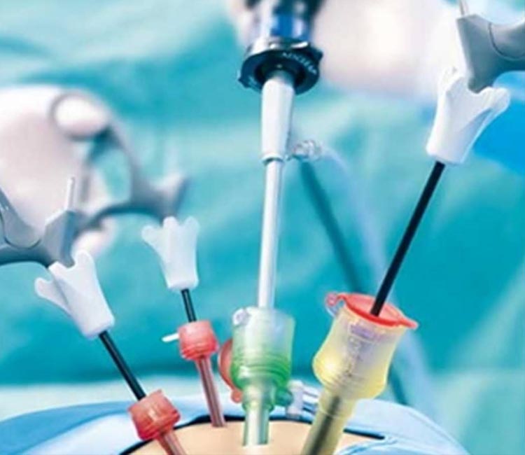 Direct Inguinal Hernia Image