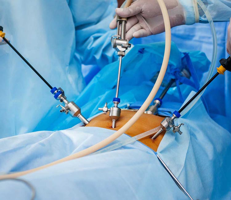 Femoral Hernia Image