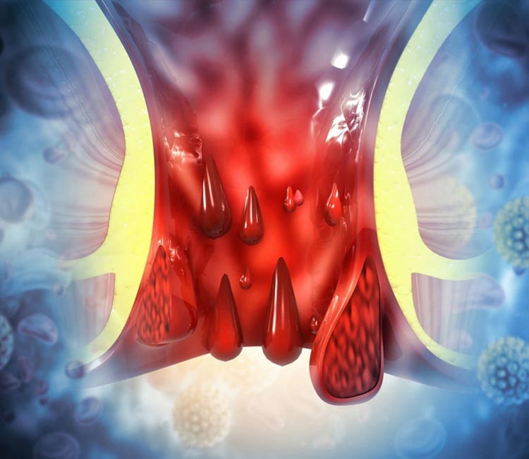 Femoral Hernia Image